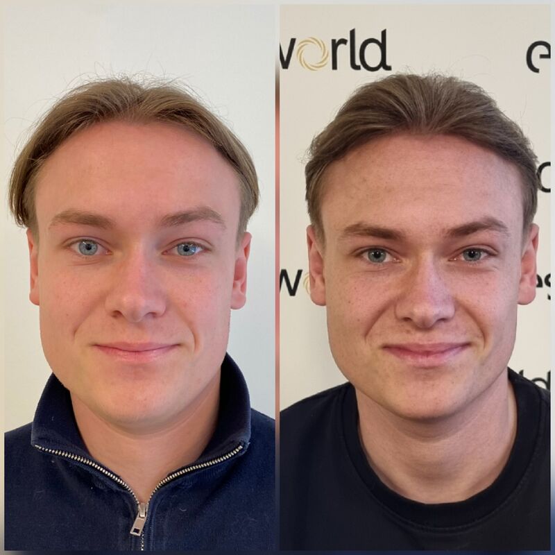 Pim, Door Laser therapie geen haartransplantatie nodig