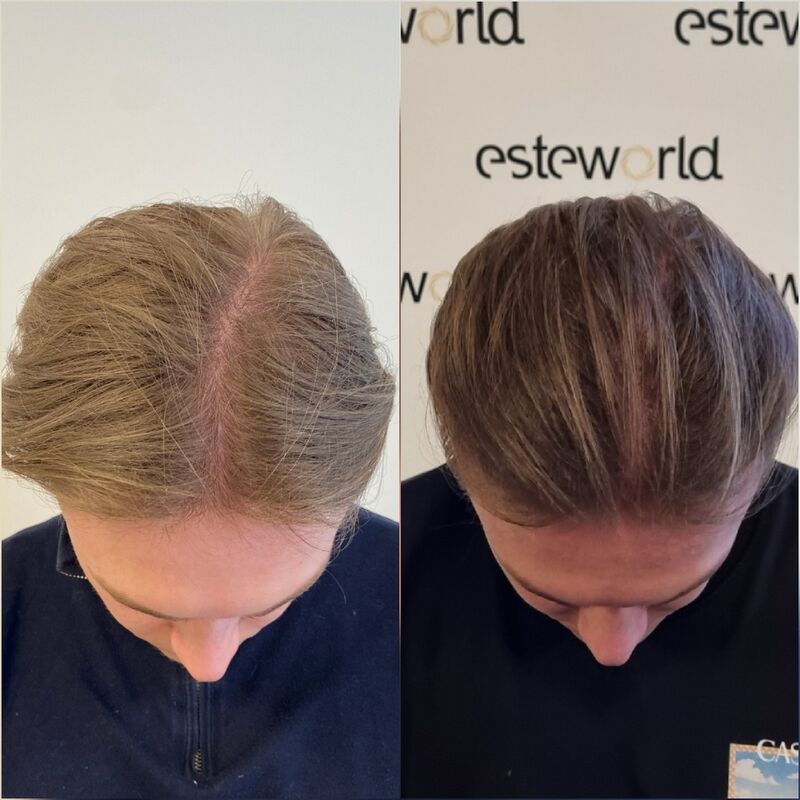 Pim, Door Laser therapie geen haartransplantatie nodig