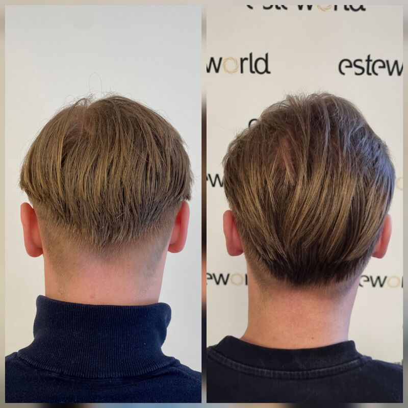 Pim, Door Laser therapie geen haartransplantatie nodig