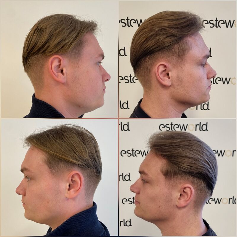 Pim, Door Laser therapie geen haartransplantatie nodig