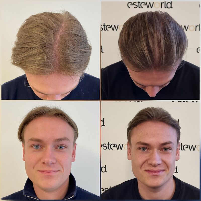 Pim, Door Laser therapie geen haartransplantatie nodig