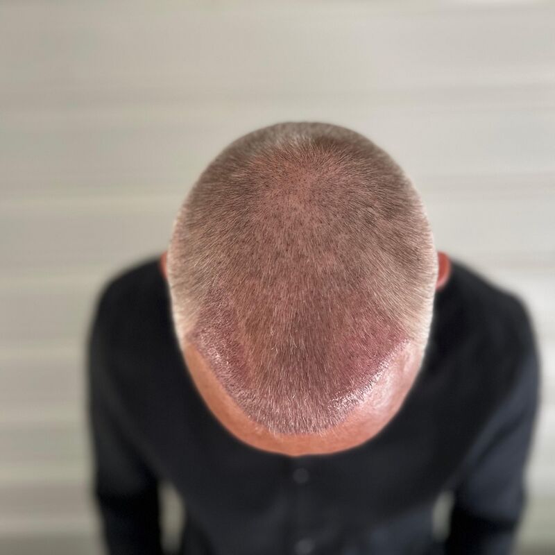 Tim, jarenlang aankijken hoe mijn haar dunner werd
