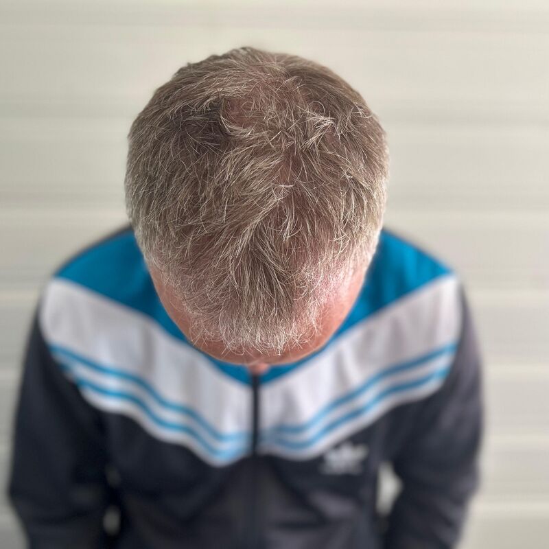 Tim, jarenlang aankijken hoe mijn haar dunner werd