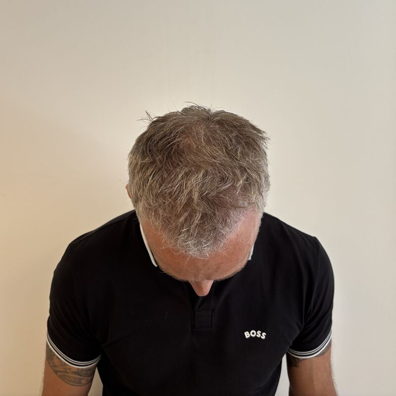 Tim, jarenlang aankijken hoe mijn haar dunner werd