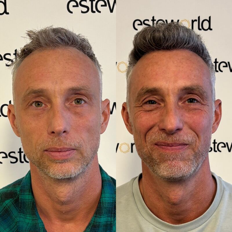 Tim, jarenlang aankijken hoe mijn haar dunner werd