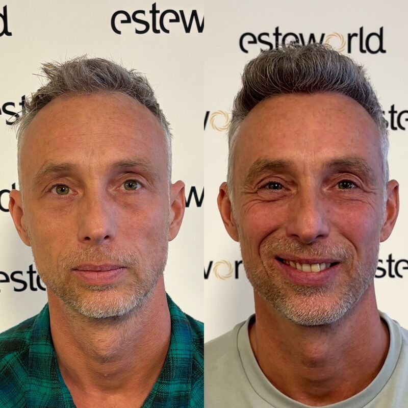 Tim, jarenlang aankijken hoe mijn haar dunner werd