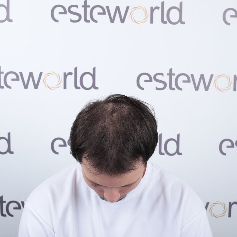 Elnur, mijn haar werd al een tijdje dunner