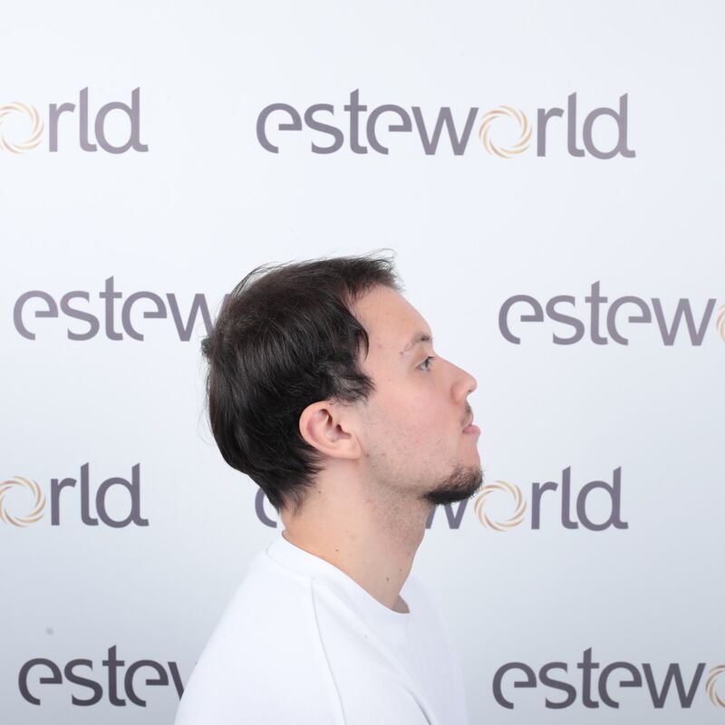 Elnur, mijn haar werd al een tijdje dunner