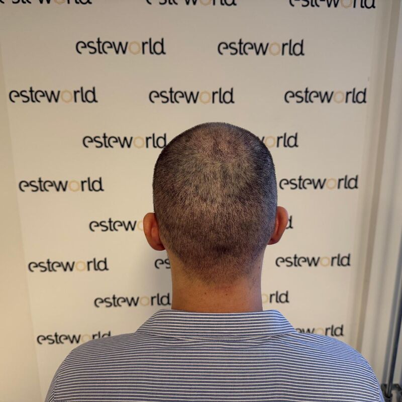 Elnur, mijn haar werd al een tijdje dunner