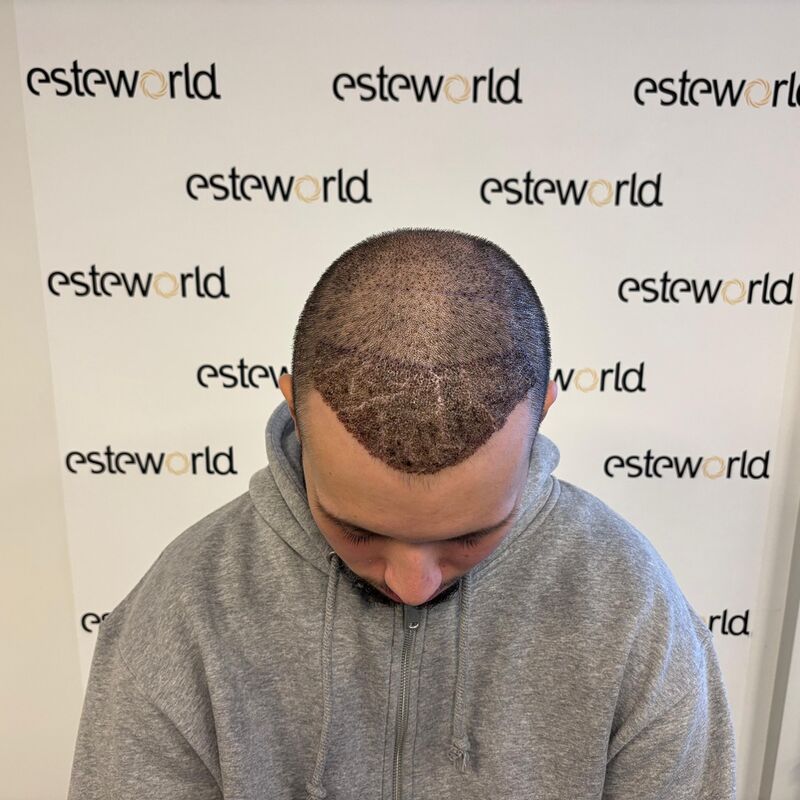 Elnur, mijn haar werd al een tijdje dunner