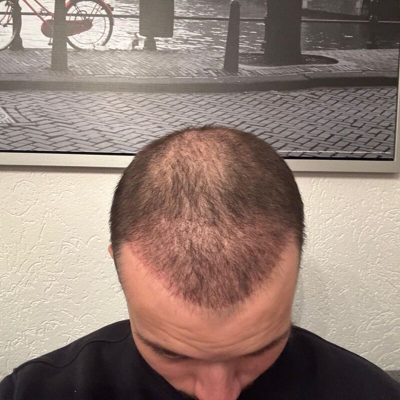 Elnur, mijn haar werd al een tijdje dunner