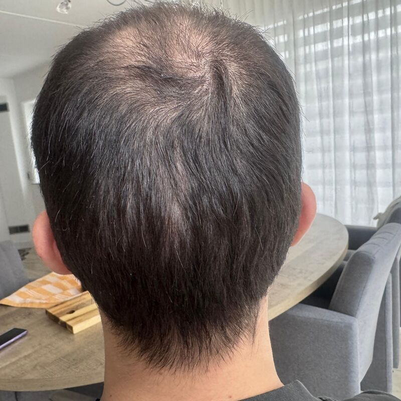 Elnur, mijn haar werd al een tijdje dunner