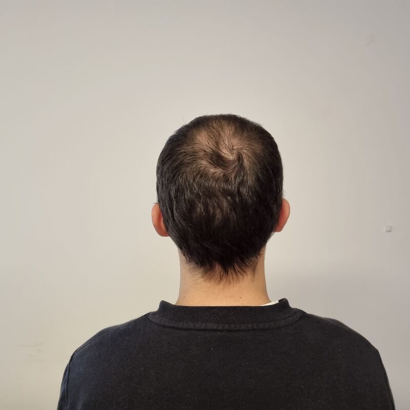 Elnur, mijn haar werd al een tijdje dunner