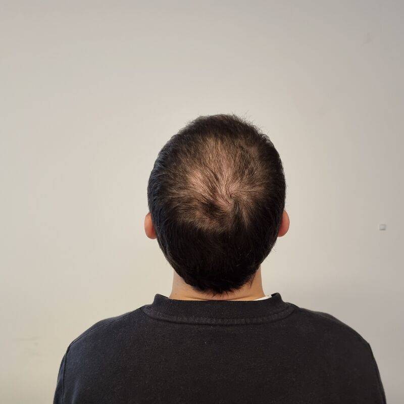 Elnur, mijn haar werd al een tijdje dunner