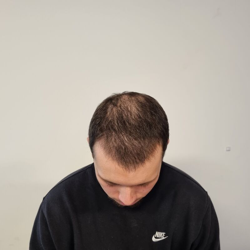 Elnur, mijn haar werd al een tijdje dunner