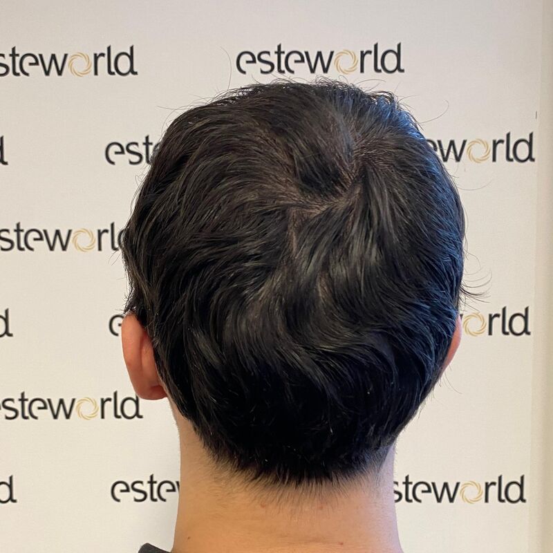 Elnur, mijn haar werd al een tijdje dunner