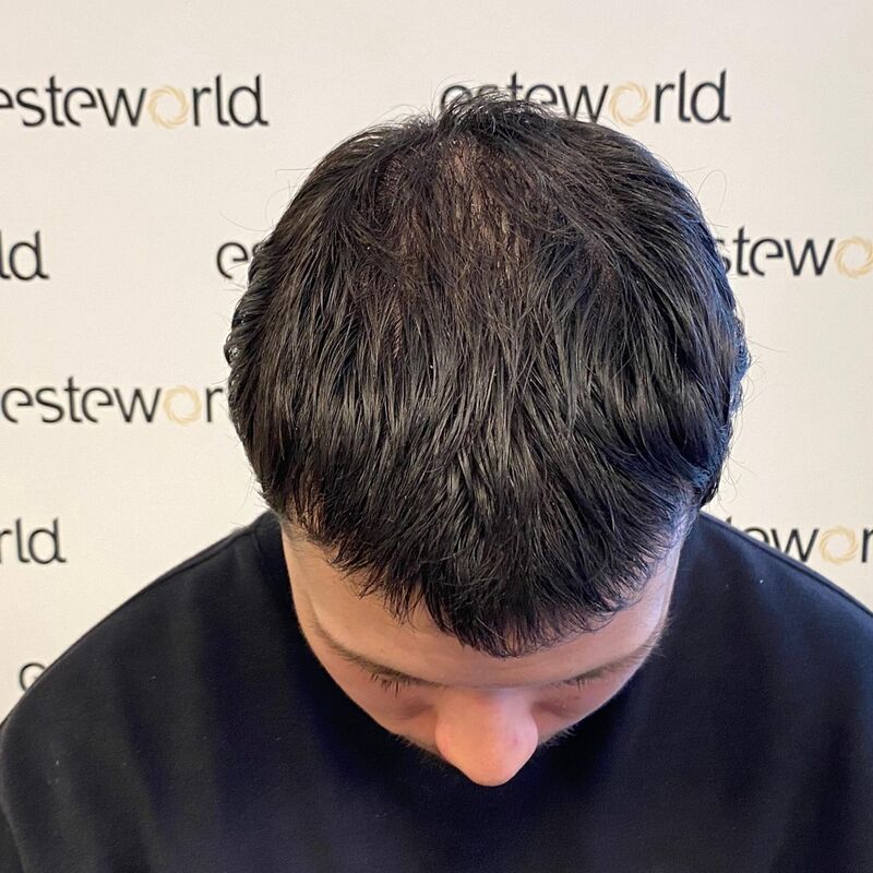 Elnur, mijn haar werd al een tijdje dunner