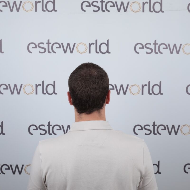 Tom, na verdoezelen met kapsels nu haartransplantatie