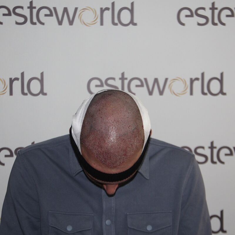 Tom, na verdoezelen met kapsels nu haartransplantatie