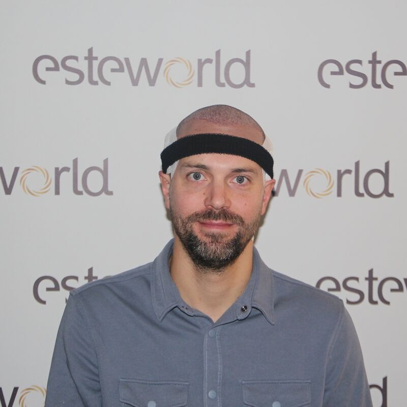 Tom, na verdoezelen met kapsels nu haartransplantatie