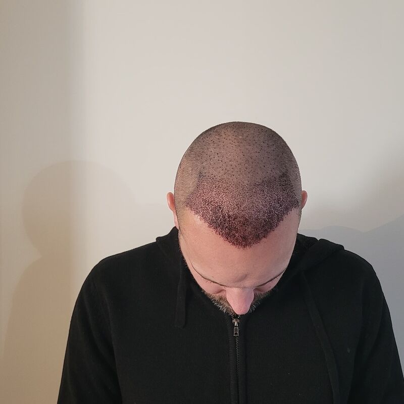 Tom, na verdoezelen met kapsels nu haartransplantatie