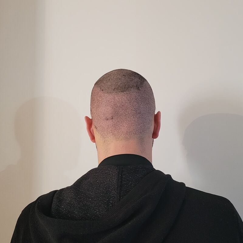 Tom, na verdoezelen met kapsels nu haartransplantatie