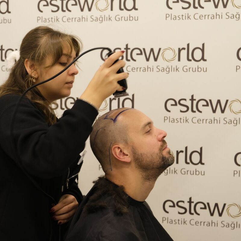 Tom, na verdoezelen met kapsels nu haartransplantatie