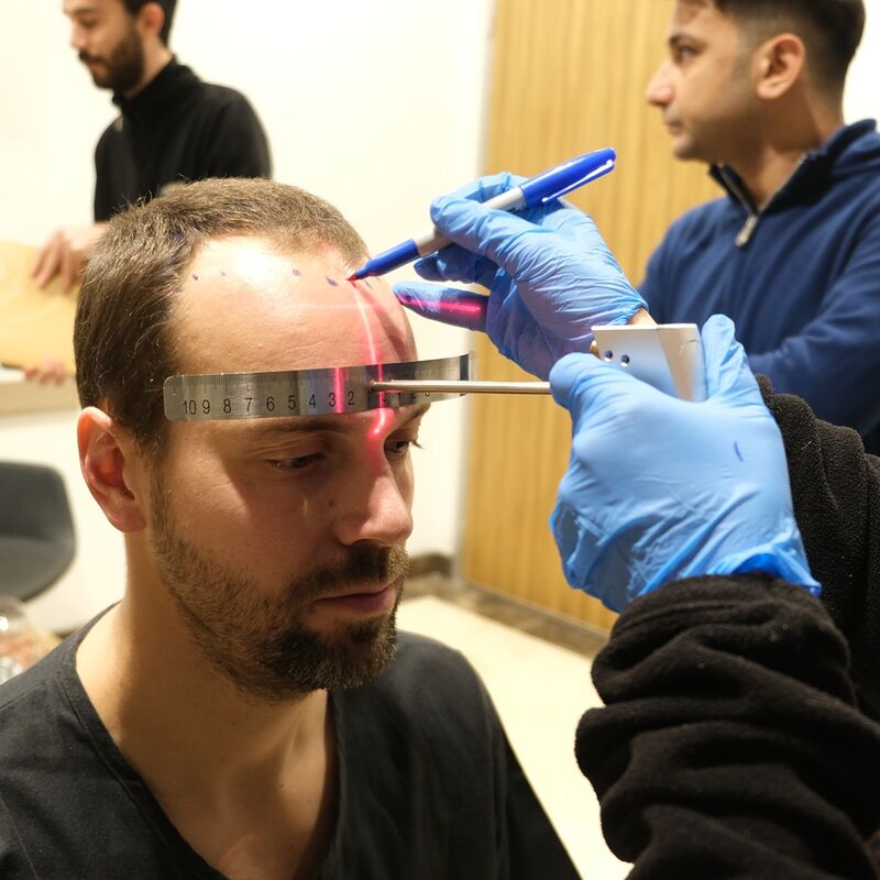 Tom, na verdoezelen met kapsels nu haartransplantatie