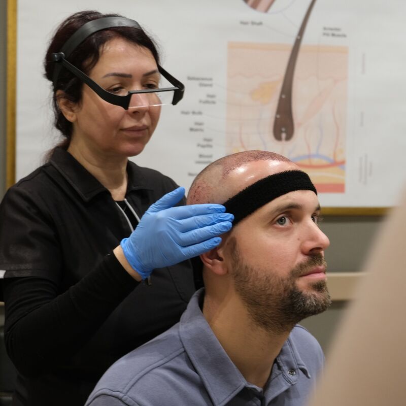Tom, na verdoezelen met kapsels nu haartransplantatie