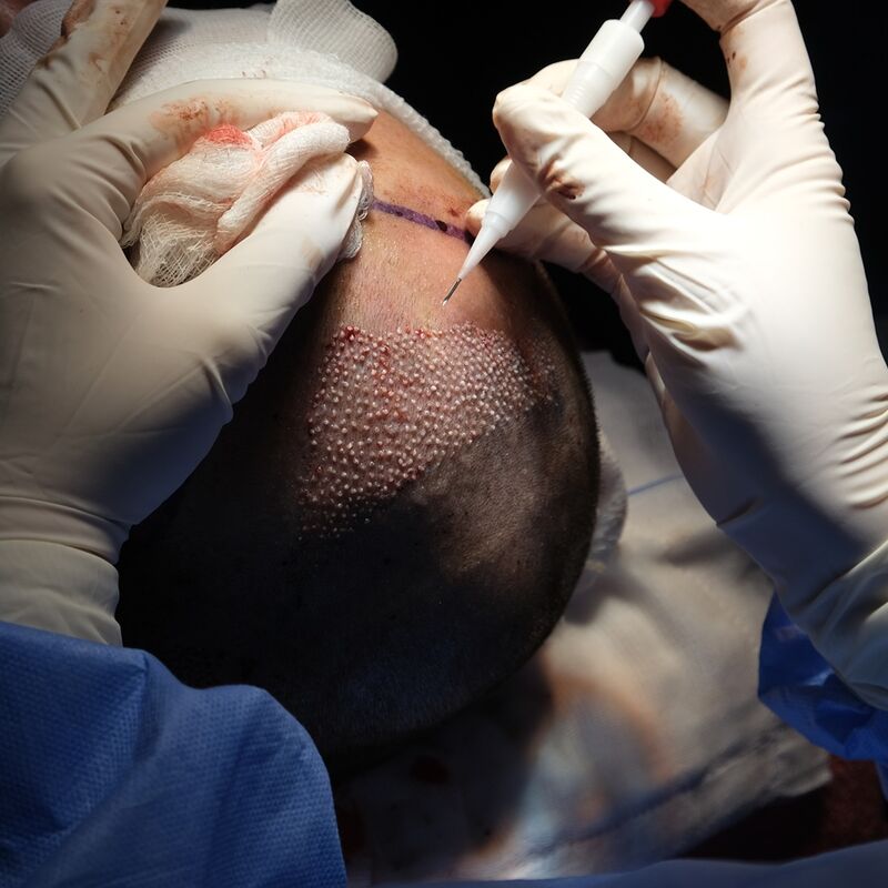 Tom, na verdoezelen met kapsels nu haartransplantatie