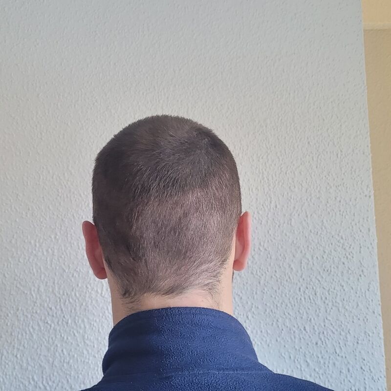 Tom, na verdoezelen met kapsels nu haartransplantatie