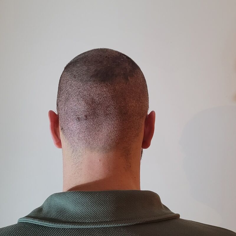 Tom, na verdoezelen met kapsels nu haartransplantatie