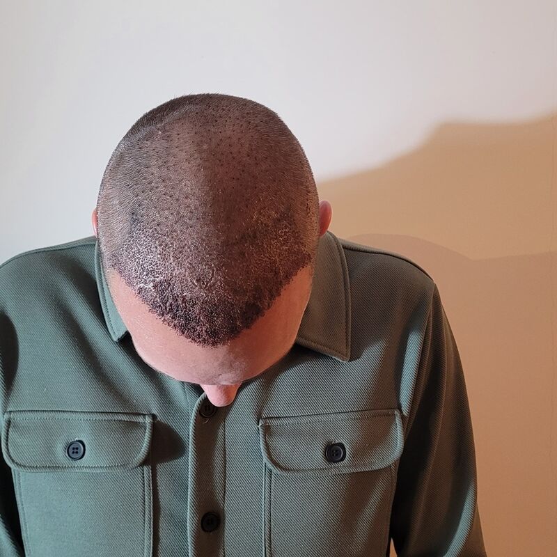 Tom, na verdoezelen met kapsels nu haartransplantatie