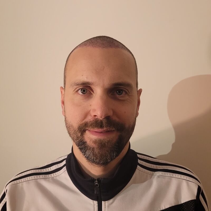 Tom, na verdoezelen met kapsels nu haartransplantatie