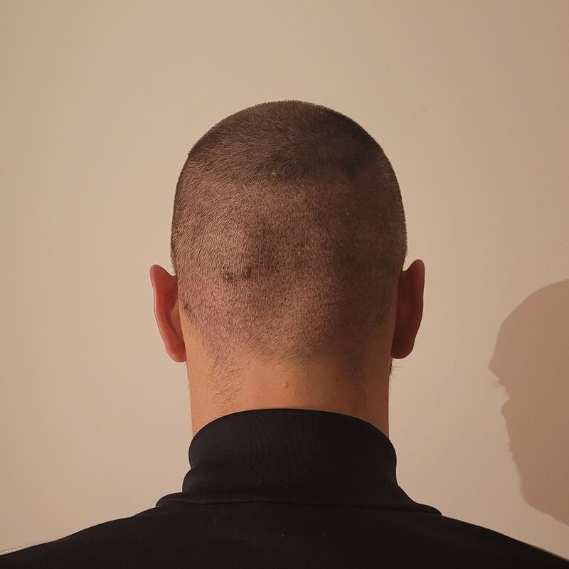 Tom, na verdoezelen met kapsels nu haartransplantatie