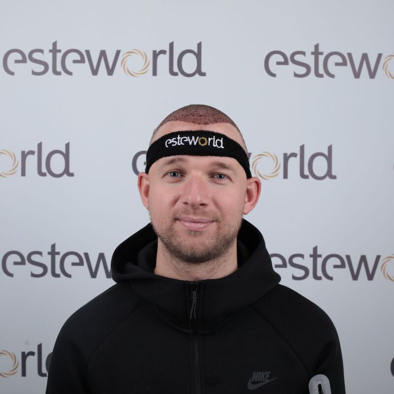 Teus, open en vertrouwelijke haartransplantatie intake in Nederland