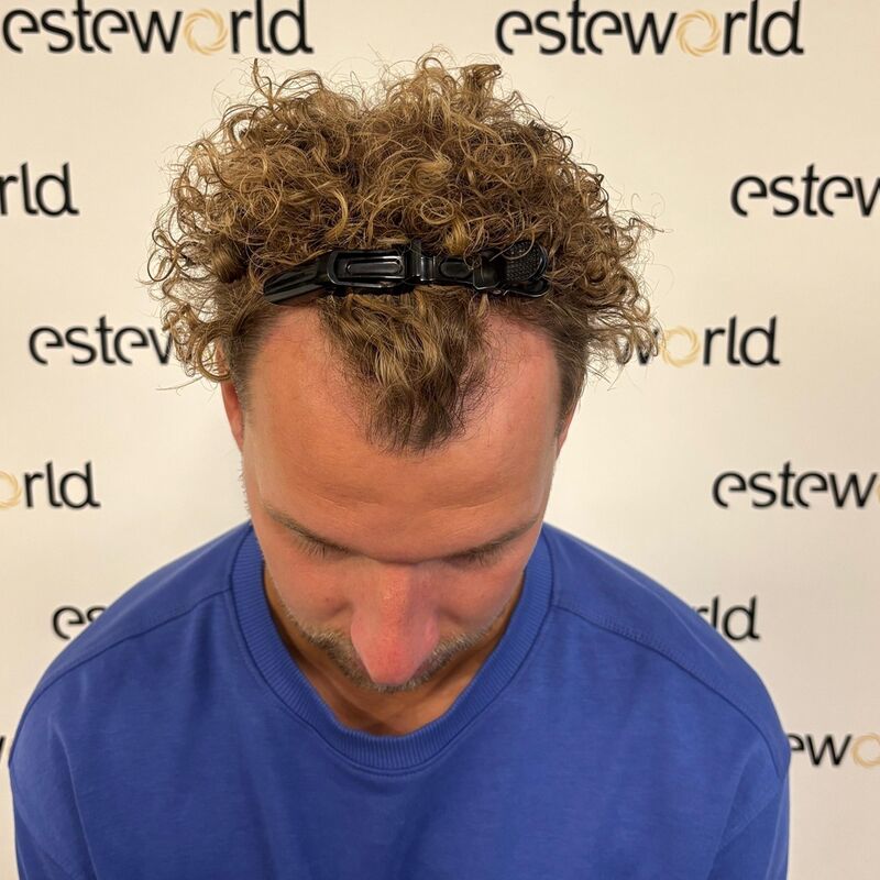 Teus, open en vertrouwelijke haartransplantatie intake in Nederland