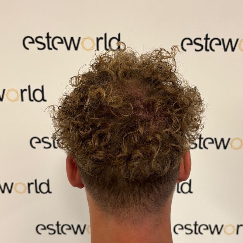 Teus, open en vertrouwelijke haartransplantatie intake in Nederland