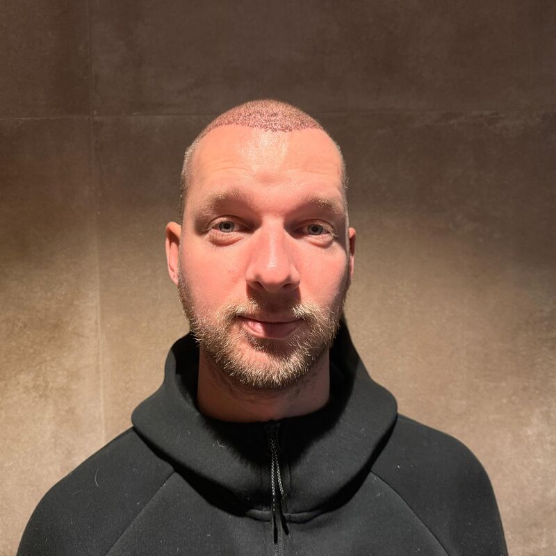 Teus, open en vertrouwelijke haartransplantatie intake in Nederland