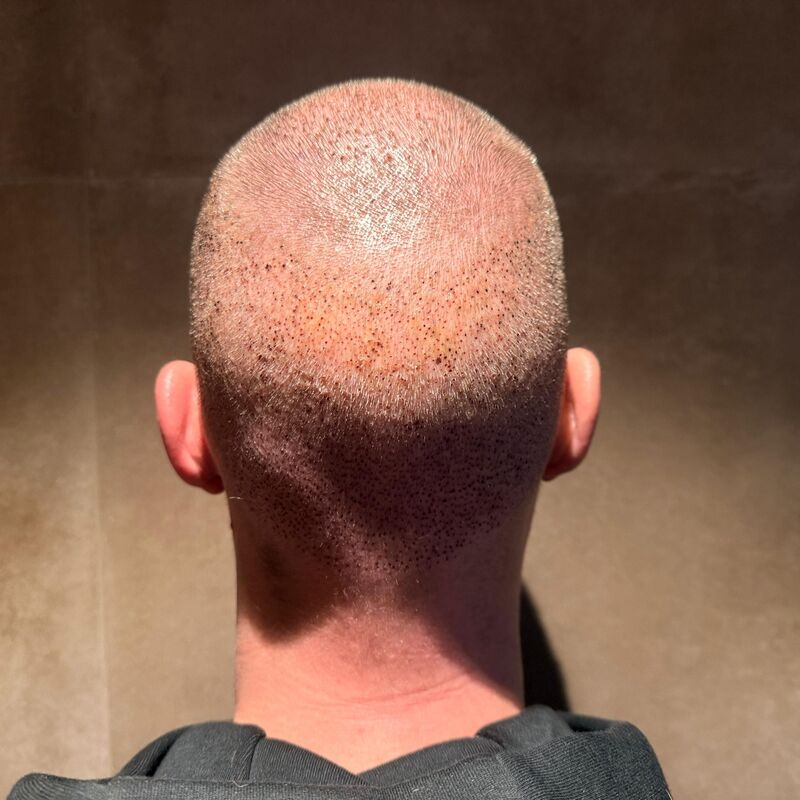 Teus, open en vertrouwelijke haartransplantatie intake in Nederland