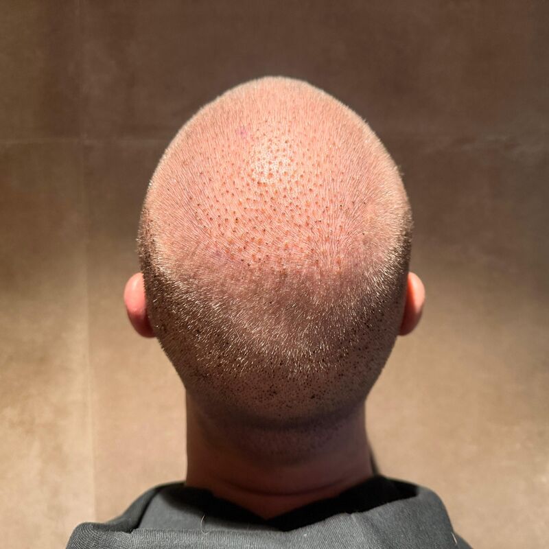 Teus, open en vertrouwelijke haartransplantatie intake in Nederland