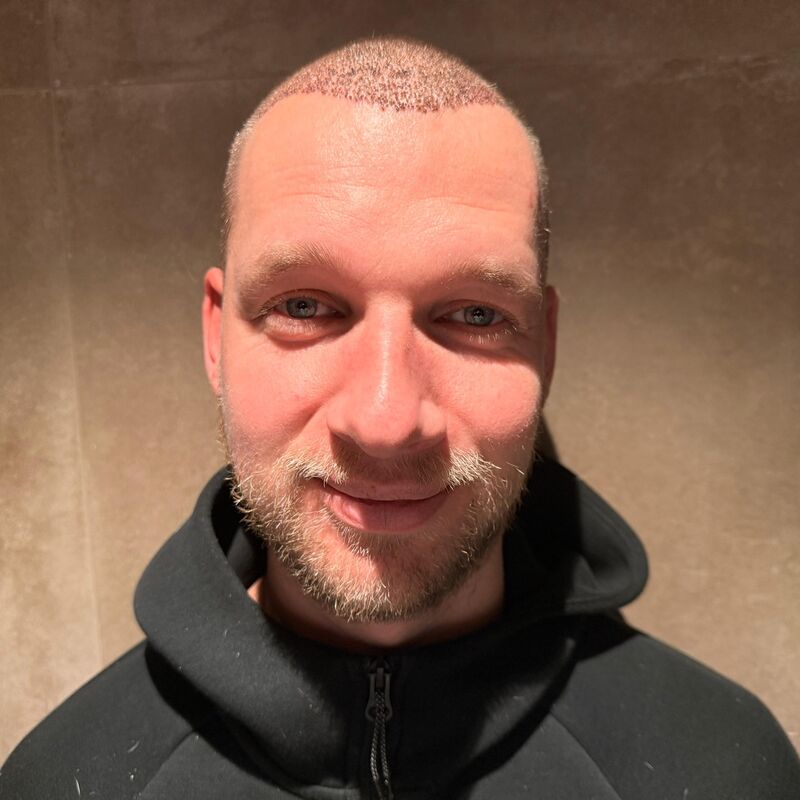 Teus, open en vertrouwelijke haartransplantatie intake in Nederland