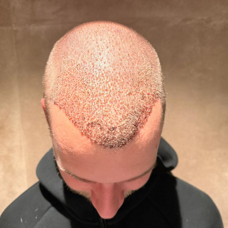 Teus, open en vertrouwelijke haartransplantatie intake in Nederland