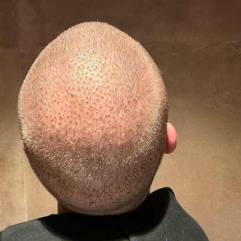 Teus, open en vertrouwelijke haartransplantatie intake in Nederland