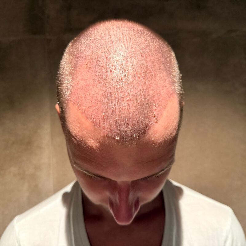 Teus, open en vertrouwelijke haartransplantatie intake in Nederland