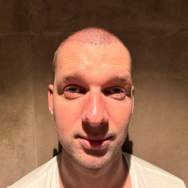 Teus, open en vertrouwelijke haartransplantatie intake in Nederland