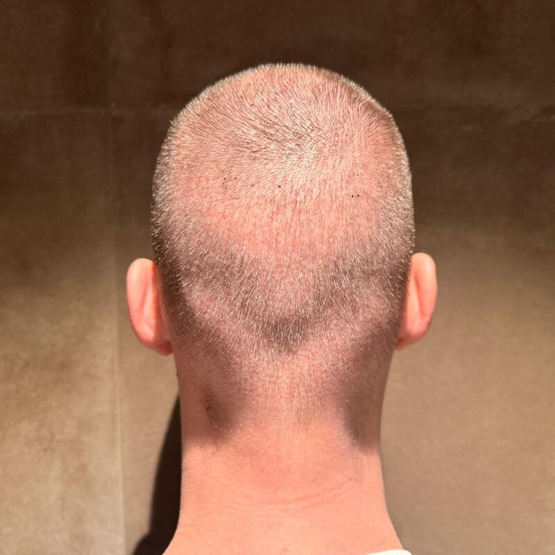 Teus, open en vertrouwelijke haartransplantatie intake in Nederland