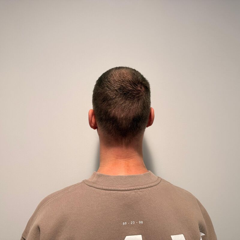 Teus, open en vertrouwelijke haartransplantatie intake in Nederland