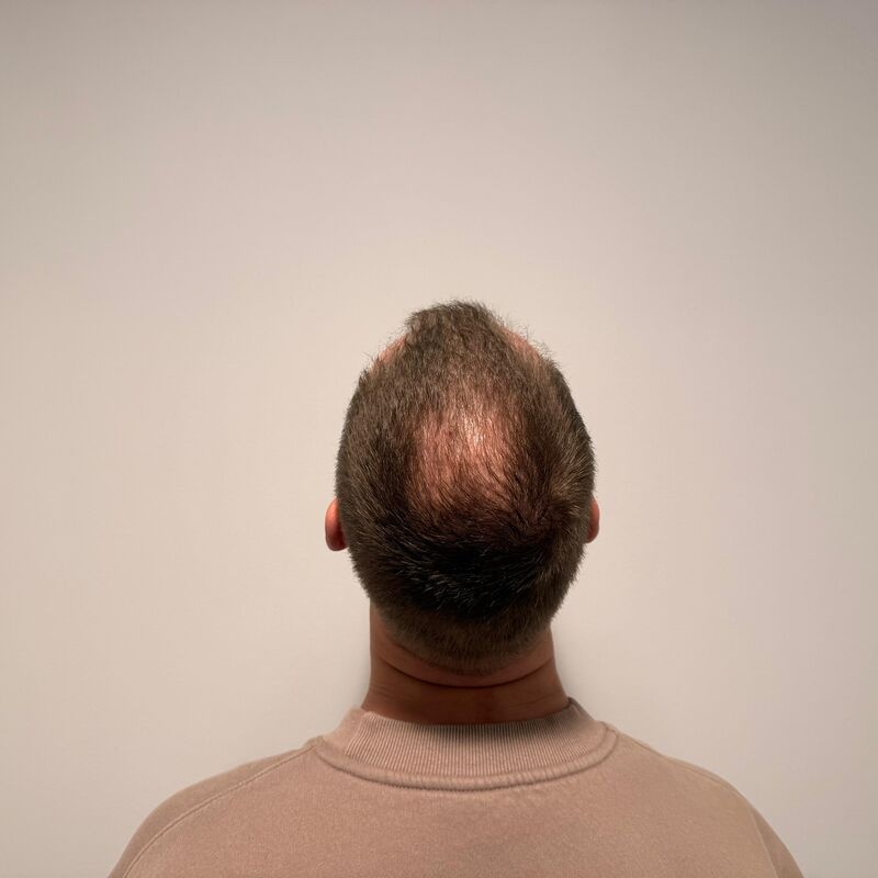 Teus, open en vertrouwelijke haartransplantatie intake in Nederland