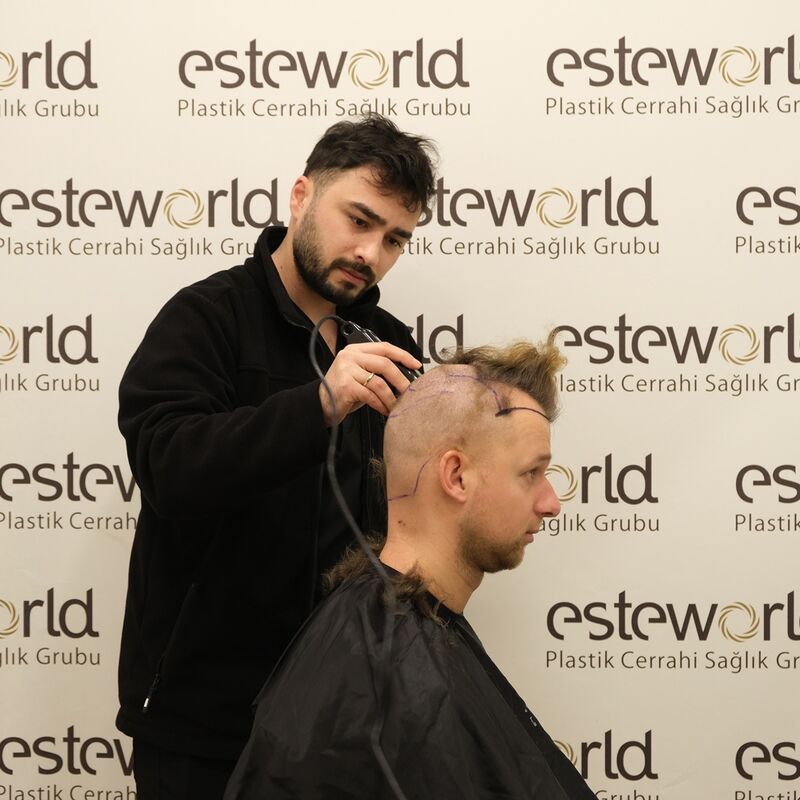 Teus, open en vertrouwelijke haartransplantatie intake in Nederland